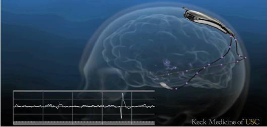 Epilepsy Breakthrough:NeuroPace implant. - touchNEUROLOGY