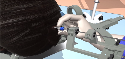 Visualase® MRI-guided Laser Ablation for Minimally Invasive Neurosurgery