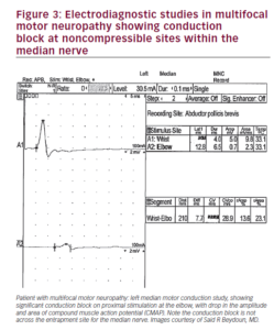 Differentiating Multifocal Motor Neuropathy from Entrapment Neuropathy ...