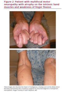 Differentiating Multifocal Motor Neuropathy from Entrapment Neuropathy