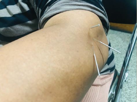 Functional and Pain Improvement in Tennis Elbow with Dry Needling ...