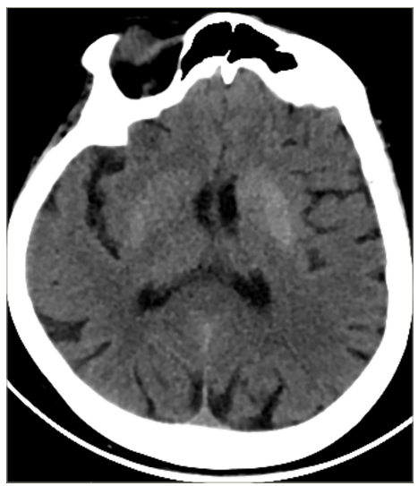 Figure 1: Brain computed tomography scan showing a hyperdense area in the left putamen and caudate nucleus