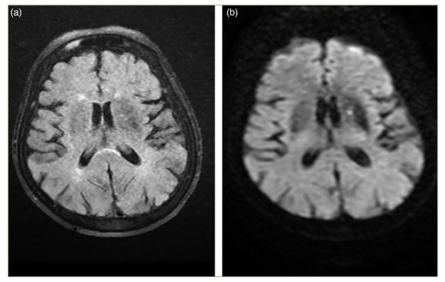 Figure 3: (a) Mild hypointensity in the left basal ganglia in the fluid-attenuated inversion recovery sequence and (b) mild hyperintensity in the left basal ganglia in the diffusion-weighted imaging sequence