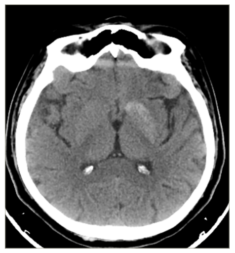 Figure 4: Brain computed tomography showing mild hyperdensity in the left striatum