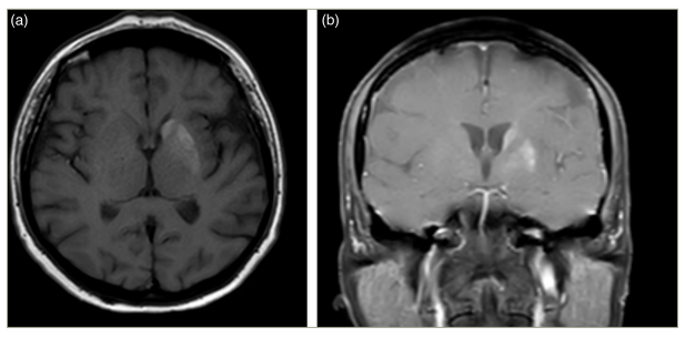 Figure 5: Hyperintensity in the left caudate nucleus and left putamen on T1-weighted sequences in both axial and coronal images