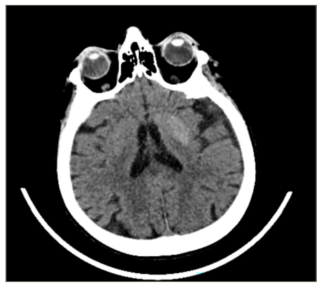 Figure 2: Brain computed tomography showing hyperdensity in the left putamen