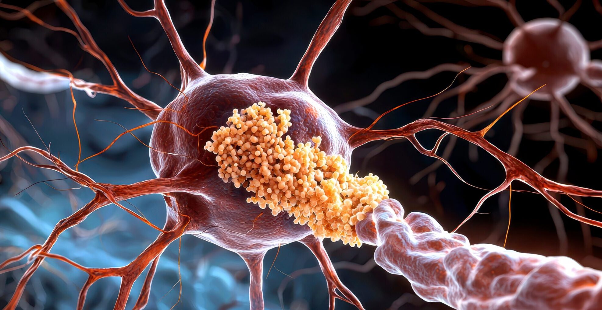 Alzheimer s amyloid plaques forming in a neuron showing cellular structure and plaque accumulation highlighting the impact on brain health.